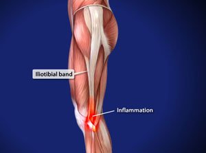 sindrome cintilla iliotibial