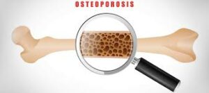 osteoporosis